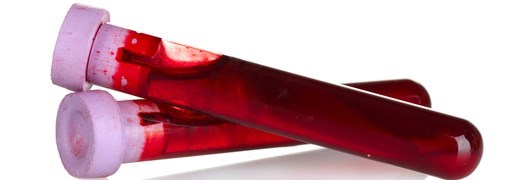  בדיקת Cardiolipin IgG - תמונה